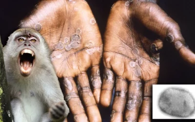 Viruela del mono: la OMS convocó a una reunión de emergencia mientras los casos se extienden por el mundo