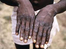 Temen que la «viruela del mono» se esté expandiendo a nivel mundial